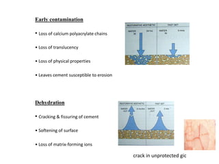 Early contamination
• Loss of calcium polyacrylate chains
• Loss of translucency
• Loss of physical properties
• Leaves cement susceptible to erosion
Dehydration
• Cracking & fissuring of cement
• Softening of surface
• Loss of matrix-forming ions
crack in unprotected gic
 