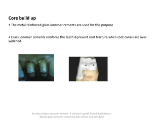 Core build up
• The metal reinforced glass ionomer cements are used for this purpose
• Glass ionomer cements reinforce the teeth &prevent root fracture when root canals are over
widened.
An atlas of glass ionomer cement- A clinician's guide 3rd edi by Graham J
Mount glass ionomer cement by Alan wilson and john kent
 