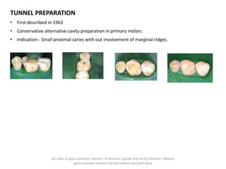TUNNEL PREPARATION
• First described in 1963
• Conservative alternative cavity preparation in primary molars.
• Indication:- Small proximal caries with out involvement of marginal ridges.
An atlas of glass ionomer cement- A clinician's guide 3rd edi by Graham J Mount
glass ionomer cement by Alan wilson and john kent
 
