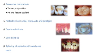 4. Preventive restorations
• Tunnel preparation
• Pit and fissure sealant
5. Protective liner under composite and amalgam
6. Dentin substitute
7. Core build up
8. Splinting of periodontally weakened
teeth
 
