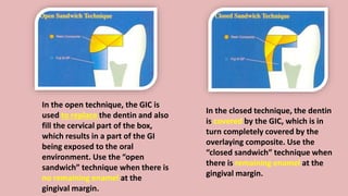 In the open technique, the GIC is
used to replace the dentin and also
fill the cervical part of the box,
which results in a part of the GI
being exposed to the oral
environment. Use the “open
sandwich” technique when there is
no remaining enamel at the
gingival margin.
In the closed technique, the dentin
is covered by the GIC, which is in
turn completely covered by the
overlaying composite. Use the
“closed sandwich” technique when
there is remaining enamel at the
gingival margin.
 