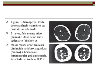 Figura 1 - Sarcopenia. Corte de ressonância magnética da coxa de um adulto de 21 anos, fisicamente ativo (acima) e idoso de 63 anos, sedentário (abaixo). A massa muscular (cinza) está diminuída no idoso; a gordura (branco) subcutânea e intramuscular está aumentada. Adaptada de Roubenoff R 5. 