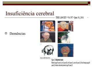 Insuficiência cerebral Demências 