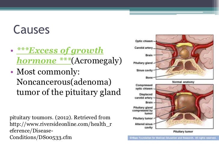 Gigantism 120223070434-phpapp01