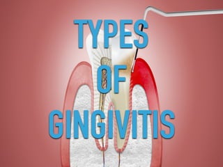 TYPES
OF
GINGIVITIS
 