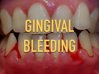 GINGIVAL
BLEEDING
 