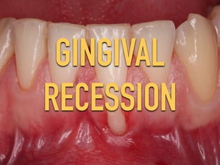 GINGIVAL
RECESSION
 