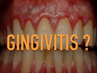Gigival inflammation | PPT