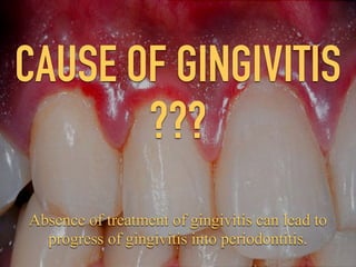 CAUSE OF GINGIVITIS
???
Absence of treatment of gingivitis can lead to
progress of gingivitis into periodontitis.
 