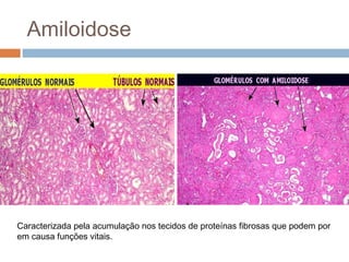 Amiloidose
Caracterizada pela acumulação nos tecidos de proteínas fibrosas que podem por
em causa funções vitais.
 