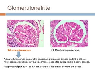 Glomerulonefrite
Gl. membranosa Gl. Membrano-proliferativa.
A imunoflurescência demonstra depósitos granulosos difusos de IgG e C3 e a
microscopia electrónica revela tipicamente depósitos subepiteliais electro-densos.
Responsável por 30% de SN em adultos. Causa mais comum em idosos.
 