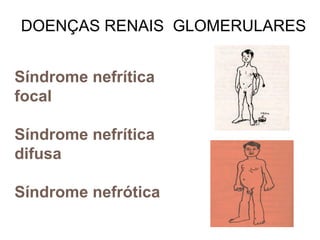 Síndrome nefrítica
focal
Síndrome nefrítica
difusa
Síndrome nefrótica
DOENÇAS RENAIS GLOMERULARES
 