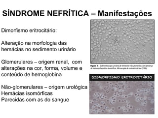 Dimorfismo eritrocitário:
Alteração na morfologia das
hemácias no sedimento urinário
Glomerulares – origem renal, com
alterações na cor, forma, volume e
conteúdo de hemoglobina
Não-glomerulares – origem urológica
Hemácias isomórficas
Parecidas com as do sangue
SÍNDROME NEFRÍTICA – Manifestações
 