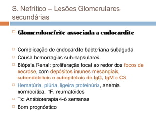 S. Nefrítico – Lesões Glomerulares
secundárias
 Glomerulonefrite associada a endocardite
 Complicação de endocardite bacteriana subaguda
 Causa hemorragias sub-capsulares
 Biópsia Renal: proliferação focal ao redor dos focos de
necrose, com depósitos imunes mesangiais,
subendoteliais e subepiteliais de IgG, IgM e C3
 Hematúria, piúria, ligeira proteinúria, anemia
normocítica, ↑F. reumatóides
 Tx: Antibioterapia 4-6 semanas
 Bom prognóstico
 