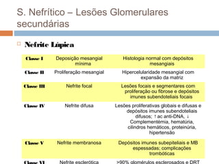 S. Nefrítico – Lesões Glomerulares
secundárias
 Nefrite Lúpica
Classe I Deposição mesangial
mínima
Histologia normal com depósitos
mesangiais
Classe II Proliferação mesangial Hipercelularidade mesangial com
expansão da matriz
Classe III Nefrite focal Lesões focais e segmentares com
proliferação ou fibrose e depósitos
imunes subendoteliais focais
Classe IV Nefrite difusa Lesões proliferativas globais e difusas e
depósitos imunes subendoteliais
difusos; ↑ac anti-DNA, ↓
Complementémia, hematúria,
cilindros hemáticos, proteinúria,
hipertensão
Classe V Nefrite membranosa Depósitos imunes subepiteliais e MB
espessadas; complicações
trombóticas
Nefrite esclerótica >90% glomérulos esclerosados e DRT
 