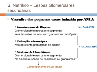 S. Nefrítico – Lesões Glomerulares
secundárias
 Vasculite dos pequenos vasos induzida porANCA
 Granulomatose de Wagener Ac. Anti-PR3
Glomerulonefrite necrosante segmentar
sem depósitos imunes, com granulomas na biópsia
 Poliangiite microscópica
Não apresenta granulomas na biópsia
 Síndrome de Churg-Strauss
Glomerulonefrite necrosante segmentar
Na biópsia ausência de eosinófilos ou granulomas
Ac. Anti-MPO
Glomerulonefrite Pauci-imune
 