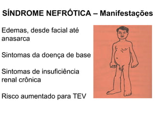 Edemas, desde facial até
anasarca
Sintomas da doença de base
Sintomas de insuficiência
renal crônica
Risco aumentado para TEV
SÍNDROME NEFRÓTICA – Manifestações
 