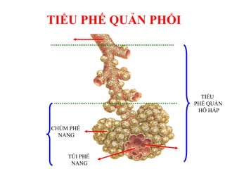 CHÙM PHẾ
NANG
TÖI PHẾ
NANG
TIỂU
PHẾ QUẢN
HÔ HẤP
TIỂU PHẾ QUẢN PHỔI
 