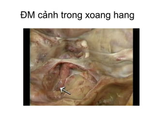 ĐM cảnh trong xoang hang
 