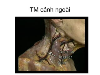 TM cảnh ngoài
 