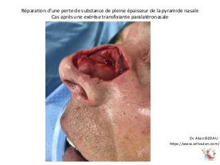 Réparation d’une perte de substance de pleine épaisseur de la pyramide nasale
Cas après une exérèse transfixiante paralatéronasale
https://www.orltoulon.com/
Dr. Alain BIZEAU
 