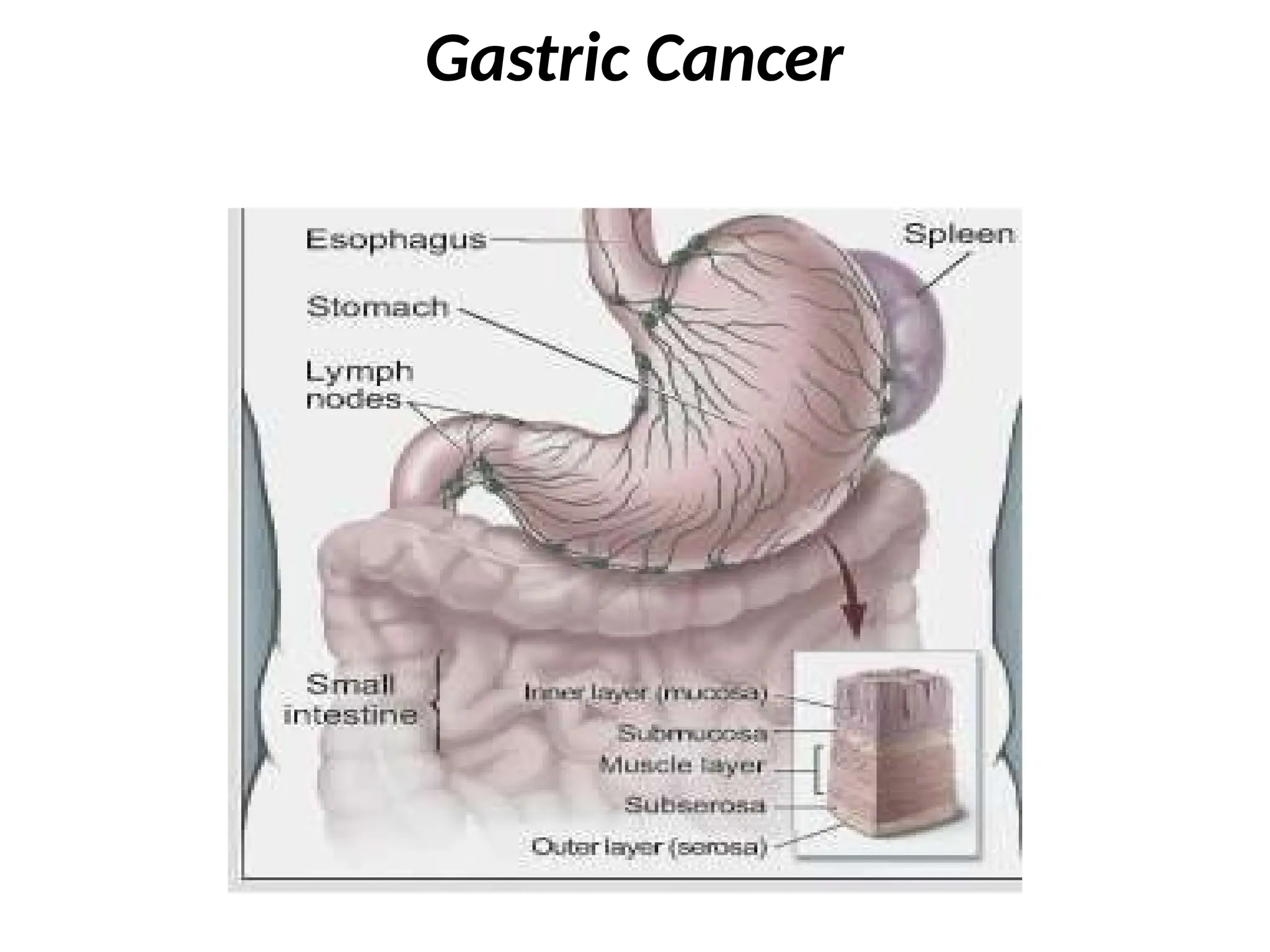 Gastric Cancer
 
