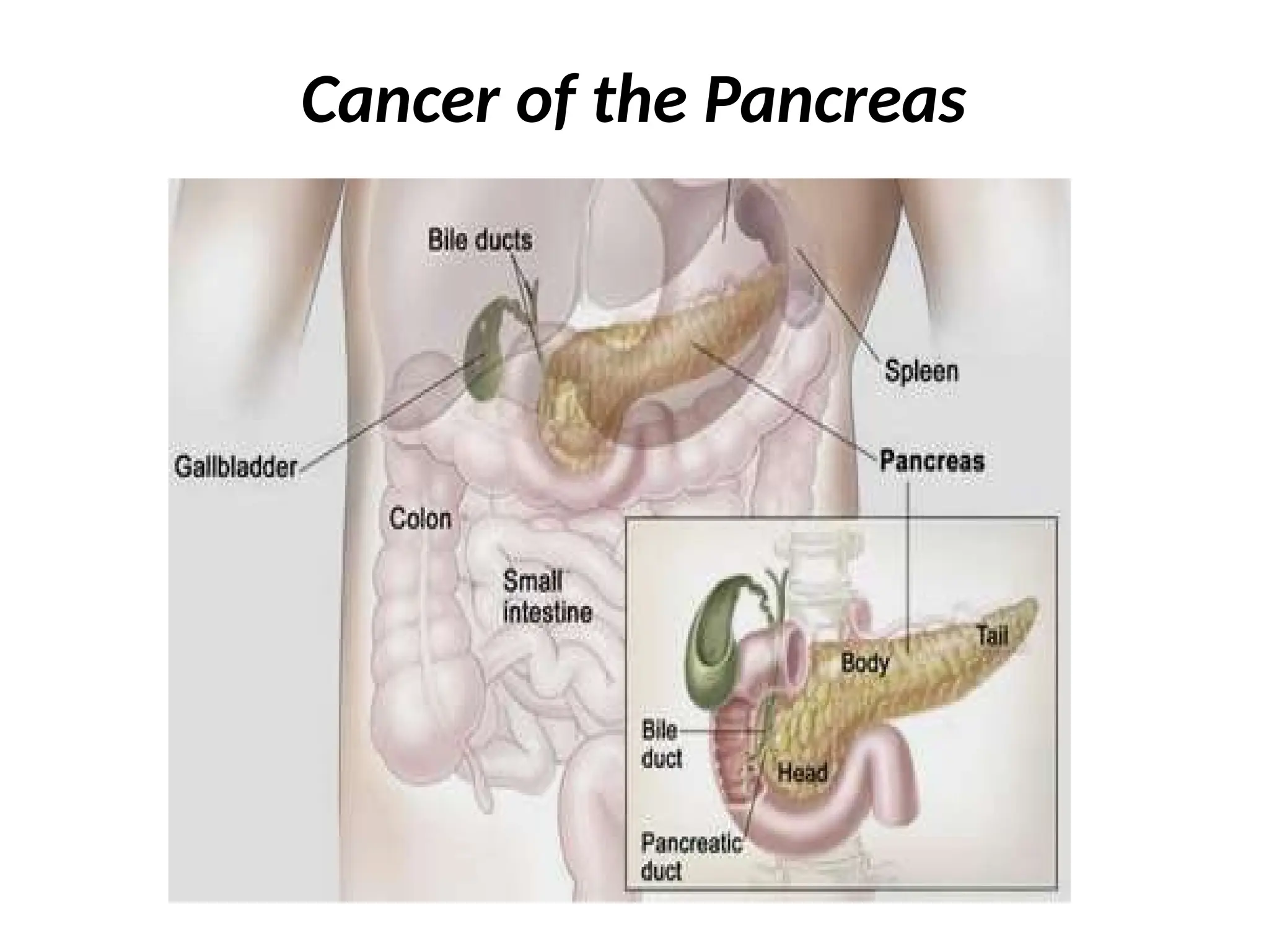 Cancer of the Pancreas
 