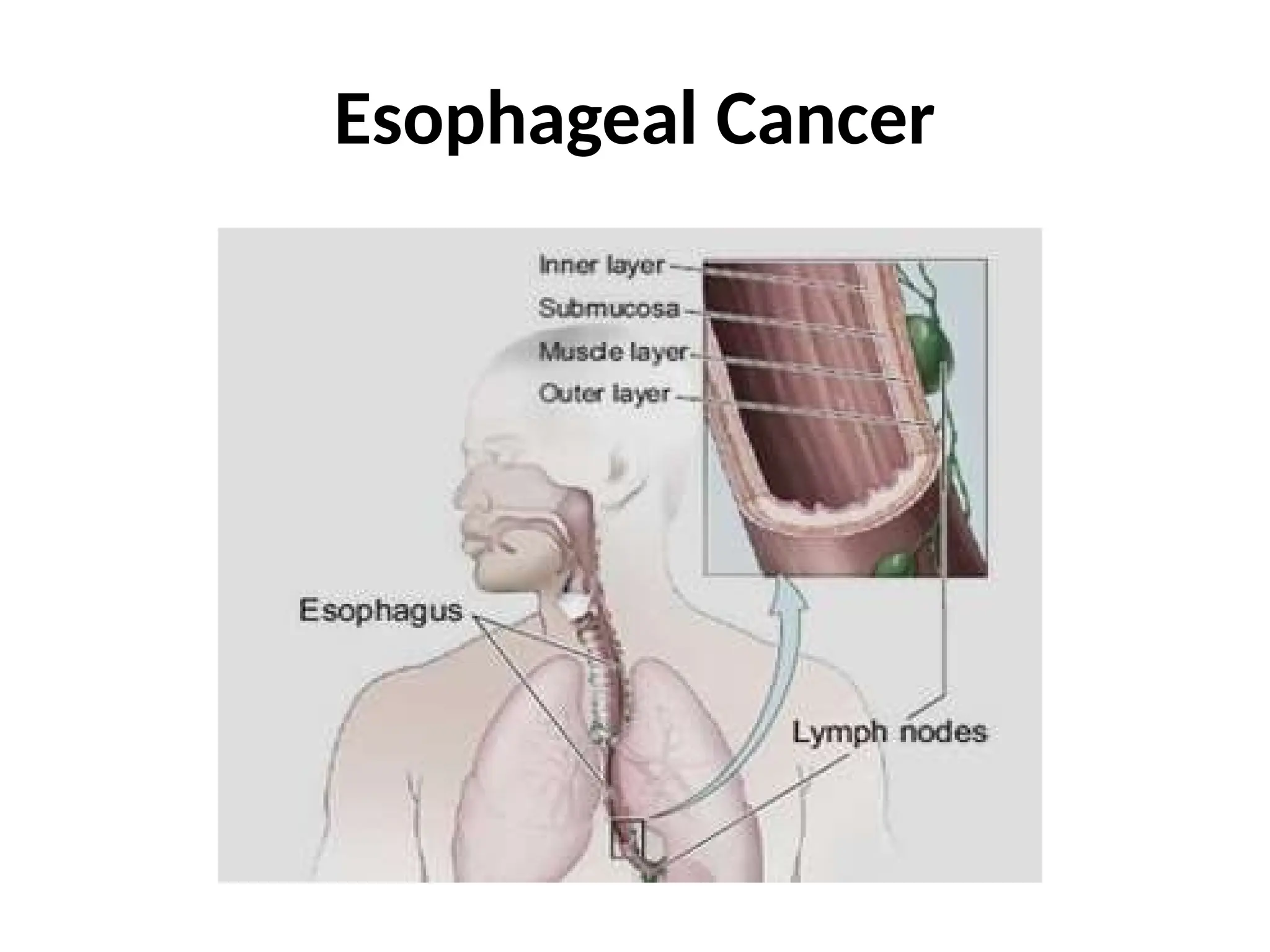 Esophageal Cancer
 