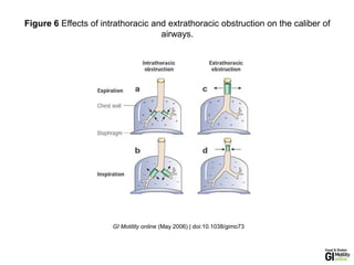 GI Motility online (May 2006) | doi:10.1038/gimo73
Figure 6 Effects of intrathoracic and extrathoracic obstruction on the caliber of
airways.
 