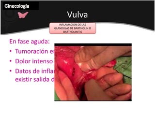Dolor abdominal de origenginecológicoGinecología DOLOR RELACIONADO CON LA MENSTRUACION+F  en las consultas ginecológicasDolor clínico limitado antes de este periodo (dismenorrea).Dismenorrea primaria: sin lesión demostrable, y es característica común de los ciclos menstruales ovulatorios.Dismenorrea secundaria: relacionada a endometriosis, estenosis cervical o inflamación pélvica. 