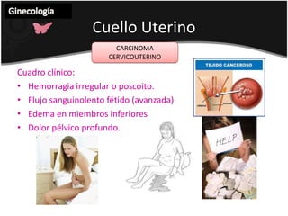 Protrusión de las membranas a vagina en forma de reloj de arena, con si consiguiente rotura, ocasiona infertilidad.Dx: HCEl paso del dilatador de Hergar #8 por el orifico cervical 