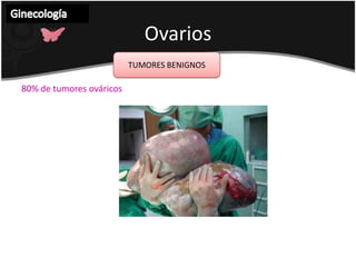 Histerectomía total con resección superior del tercio superior de la vagina , cuando hay paridad satisfecha.Ginecología 