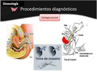 Ginecología Procedimientos diagnósticos  Citología cervical 