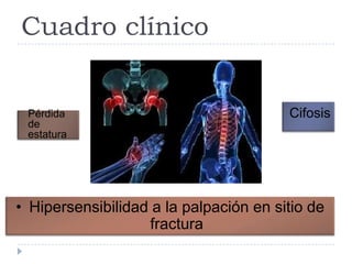 Cuadro clínico
CifosisPérdida
de
estatura
• Hipersensibilidad a la palpación en sitio de
fractura
 