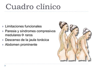Cuadro clínico
 Limitaciones funcionales
 Paresia y síndromes compresivos
medulares raros
 Descenso de la jaula torácica
 Abdomen prominente
 