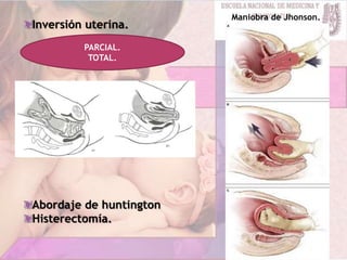 Inversión uterina.
Abordaje de huntington
Histerectomía.
Maniobra de Jhonson.
PARCIAL.
TOTAL.
 