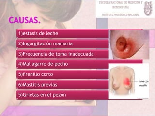 1)estasis de leche
2)Ingurgitación mamaria
3)Frecuencia de toma inadecuada
4)Mal agarre de pecho
5)Frenillo corto
6)Mastitis previas
5)Grietas en el pezón
 