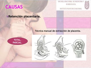 Retención placentaria.
TOTAL.
PARCIAL.
Técnica manual de extracción de placenta.
 