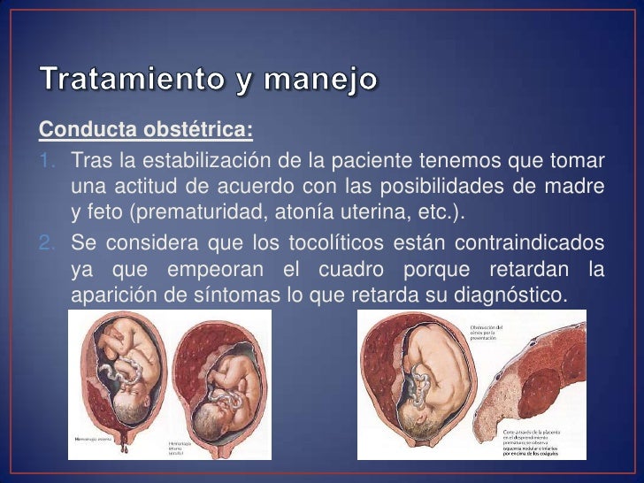 Desprendimiento prematuro de placenta