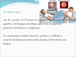 3) Colposcopia:  con Ac. acético  al 5% pone en evidencia las lesiones del epitelio y lo blanquea de blanco pues este coagula las proteínas del núcleo y citoplasma . Se encuentran en labios menores, perineo, vestíbulo y zona de trasformación del cuello uterino. Debe de hacerse biopsia 