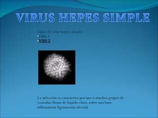 Tipos de virus herpes simple: VHS-1 VHS-2 La infección se caracteriza por uno o muchos grupos de vesículas llenas de liquido claro, sobre una base  inflamatoria ligeramente elevada 