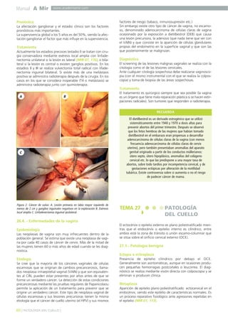 Manual A Mir

www.academiamir.com

Pronóstico
La afectación ganglionar y el estadio clínico son los factores
pronósticos más importantes.
La supervivencia global a los 5 años es del 50%, siendo la afectación ganglionar el factor que más influye en la supervivencia.

Tratamiento
Actualmente los estadios precoces (estadio I) se tratan con cirugía conservadora mediante exéresis local amplia con linfadenectomía unilateral si la lesión es lateral (MIR 07, 176), o bilateral si la lesión es central o existen ganglios positivos. En los
estadios II y III se realiza vulvectomía total radical con lifadenectomía inguinal bilateral. Si existe más de una metástasis
positiva se administra radioterapia después de la cirugía. En los
casos en los que se considera inoperable (T4 o metástasis) se
administra radioterapia junto con quimioterapia.

factores de riesgo (tabaco, inmunosupresión etc.)
Sin embargo existe otro tipo de cáncer de vagina, no escamoso, denominado adenocarcinoma de células claras de vagina
ocasionado por la exposición a dietilbestrol (DEB) que causa
una lesión precursora, la adenosis (que nada tiene que ver con
el VAIN) y que consiste en la aparición de células glandulares
propias del endometrio en la superficie vaginal y que son las
que posteriormente se malignizan.

Diagnóstico
El screening de las lesiones malignas vaginales se realiza con la
citología como el de las lesiones cervicales.
Ante cualquier citología sospechosa debe realizarse vaginoscopia (con el mismo instrumental con el que se realiza la colposcopia) y toma de biopsia de las áreas sospechosas.

Tratamiento
A

B

El tratamiento es quirúrgico siempre que sea posible (la vagina
es un órgano que tiene mala reparación plástica si se hacen extirpaciones radicales). Son tumores que responden a radioterapia.
RECUERDA

C

Figura 2. Cáncer de vulva: A. Lesión primaria en labio mayor izquierdo de
menos de 2 cm y ganglios inguinales negativos en la exploración B. Exéresis
local amplia C. Linfadenectomía inguinal ipsilateral.

El dietilbestrol es un derivado estrogénico que se utilizó
sistemáticamente entre 1940 y 1970 a dosis altas para
prevenir abortos del primer trimestre. Después se observó
que los fetos hembras de las mujeres que habían tomado
dietilbestrol en el embarazo eran propensas a desarrollar
adenocarcinoma de células claras de la vagina (con menos
frecuencia adenocarcinoma de células claras de cervix
uterino), pero también presentaban anomalías del aparato
genital originado a partir de los conductos müllerianos:
útero septo, útero hipoplásico, anomalías del colágeno
cervical etc. lo que las predispone a una mayor tasa de
abortos, sobre todo tardíos por incompetencia cervical, y de
gestaciones ectópicas por alteración de la motilidad
tubárica. Existe controversia sobre si aumenta o no el riesgo
de padecer cáncer de mama.

TEMA 27

PATOLOGÍA
DEL CUELLO

26.4. - Enfermedades de la vagina
Epidemiología
Las neoplasias de vagina son muy infrecuentes dentro de la
población general. Se estima que existe una neoplasia de vagina por cada 40 casos de cáncer de cervix. Más de la mitad de
las mujeres tienen 60 o más años de edad cuando se les diagnostica.

El ectocérvix o epitelio externo es plano poliestratificado mientras que el endocérvix o epitelio interno es cilíndrico, entre
ambos está la zona de tránsito o unión escamo-columnar que
se sitúa sobre el orificio cervical externo (OCE).

27.1.- Patología benigna
Ectopia o eritroplasia

Etiología
Se cree que la mayoría de los cánceres vaginales de células
escamosas que se originan de cambios precancerosos, llamados neoplasia intraepitelial vaginal (VAIN) y que son equivalentes al CIN, pueden estar presentes por años antes de que se
forme un verdadero cáncer. La detección de estas condiciones
precancerosas mediante las pruebas regulares de Papanicolaou
permite la aplicación de un tratamiento para prevenir que se
origine un verdadero cáncer. Este tipo de neoplasia vaginal de
células escamosas y sus lesiones precursoras tienen la misma
etiología que el cáncer de cuello uterino (el HPV) y sus mismos

60 ] PATOLOGÍA DEL CUELLO [

Presencia de epitelio cilíndrico por debajo el OCE.
Generalmente son asintomáticas, aunque en ocasiones producen pequeñas hemorragias postcoitales o leucorrea. El diagnóstico se realiza mediante visión directa con colposcopia y se
eliminan si producen clínica.

Metaplasia
Aparición de epitelio plano poliestratificado ectocervical en el
endocérvix, siendo este epitelio de características normales. Es
un proceso reparativo fisiológico ante agresiones repetidas en
el epitelio (MIR 01, 173).

 