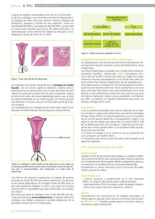 Manual A Mir

www.academiamir.com

mujeres de edades comprendidas entre los 25 y los 64 años.
La técnica citológica más conocida es el test de Papanicolau o
la citología de triple toma que obtiene muestra citológica de
endocérvix, exocérvix y fondos de saco vaginales. Tiene una
sensibilidad del 80% y una especificidad del 99%, aunque ésta
es menor para lesiones precursoras del adenocarcinoma. Su
sistematización como método de cribado ha reducido la mortalidad por cáncer de cérvix en un 50%.

Citología medio líquido /
triple toma

L-SIL / ASCUS
Test de HPV positivo

Test de HPV negativo

Colposcopia y biopsia

H-SIL
Colposcopia y biopsia

Volver al
cribado general:
citologia en 1 año

Figura 4. Cribado de lesiones epiteliales de cérvix.

Diagnóstico de lesiones de cérvix: colposcopia

Figura 2. Triple toma del test de Papanicolau.

Sin embargo está siendo sustituida por la citología en medio
líquido: con un mismo cepillo se obtienen muestra endo y
exocervical (se ha demostrado que la toma de fondo de saco
vaginal no ayuda en la detección de estas neoplasias). Mejora
la lectura por parte del anatomopatólogo puesto que, al estar
las células embebidas en un medio líquido, no forman grumos
que dificultan su lectura como en el frotis sobre porta de la técnica antigua.
Los resultados de una citología vienen informados según la clasificación de Bethesda que hemos expuesto anteriormente.

Cepillo cervical

La colposcopia es una técnica que permite el visionado del cérvix bajo lente de gran aumento y toma de biopsia de las zonas
sospechosas.
Las zonas sospechosas se pueden ver a simple vista (mosaicos,
punteados basófilos, ulceraciones (MIR), leucoplasias etc.),
con el test de Schiller o tinción del cuello con lugol (son sospechosas las lesiones yodonegativas) o con tinción del cuello con
ácido acético (las lesiones sospechosas son las acetoblancas).
Una colposcopia es satisfactoria si se ha conseguido el visionado de la unión escamo-columnar. No es satisfactoria si no se ve
esta unión por estar dentro del canal endocervical. En el caso
de que no sea satisfactoria y dado que esta unión es una zona
de máxima replicación celular y muy susceptible a la infección
por HPV, se realizará un legrado endocervical para tener un
estudio citológico de la zona.

Tratamiento
Si en la anatomía patológica que hemos obtenido de la biopsia tomada en colposcopia observamos una lesión premaligna
de bajo riesgo (CIN I), la actitud terapéutica va a ser la escisión
de las misma (asa de diatermia, criocoagulación o láser). Si la
lesión es de alto riesgo para desarrollar un cáncer (CIN II, CIN
III), se deberá practicar una conización, cuidando que los márgenes de la misma queden libres. Si no quedaran libres se practicará una reconización.
Si la lesión es maligna y es un cáncer in situ, es suficiente con
una conización con bordes libres.
El tratamiento del cáncer invasor de cervix está recogido en el
siguiente apartado.

27.3.- Carcinoma invasor de cuello
Epidemiología

Figura 3. La citología en medio líquido es más rápida (con un solo cepillo y en
un solo gesto permite tomar muestra endo y exocervical) y tiene una mejor lectura para el anatomopatólogo. Está sustituyendo a la triple toma de
Papanicolau.

Una técnica de reciente incorporación al cribado de lesiones
cervicales es el test de HPV que mide la presencia o no del virus
en las células obtenidas en la citología. El test de HPV tiene un
alto valor predictivo negativo, es decir, si la mujer no es portadora de HPV es improbable que vaya a desarrollar una neoplasia cervical.
Recuerda que tanto la citología como el test del HPV son técnicas de screening y nunca diagnósticas. Cualquier alteración
citológica nos obliga a practicar la prueba diagnóstica de la
patología cervical que es la colposcopia.

62 ] PATOLOGÍA DEL CUELLO [

Supone el 25% de los tumores ginecológicos. La máxima incidencia se da entre los 40-55 años, aunque la edad media de aparición
y la mortalidad está disminuyendo debido al diagnóstico precoz y
al aumento en la incidencia de las formas preinvasivas (SIL).
Actualmente es menos frecuente que el carcinoma de endometrio y que el de ovario.

Tipos histológicos
- Cáncer escamoso o epidermoide: es el más frecuente
(90%). Se originan del epitelio plano poliestratificado.
- Adenocarcinoma (10%): se origina a partir de epitelio cilíndrico.
- Otros (muy raros): sarcoma, melanoma, linfoma.

Clínica
Generalmente son asintomáticos. En estadios avanzados, la
metrorragia en agua de lavar carne es el síntoma más frecuente (MIR 99, 171). También puede aparecer leucorrea serosa o
purulenta y dolor tardíamente.

 