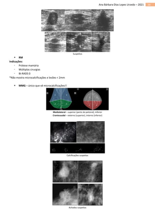 16
Ana Bárbara Dias Lopes Urzedo – 2021
Suspeitos
▪ RM
Indicações:
 Prótese mamária
 Múltiplas cirurgias
 BI-RADS 0
*Não mostra microcalcificações e lesões < 2mm
▪ MMG – único que vê microcalcificações!!
Mediolateral – superior (perto do peitoral), inferior
Craniocaudal – externo (superior), interno (inferior)
Calcificações suspeitas
Achados suspeitos
 