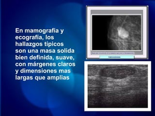En mamografía y
ecografía, los
hallazgos típicos
son una masa solida
bien definida, suave,
con márgenes claros
y dimensiones mas
largas que amplias
 