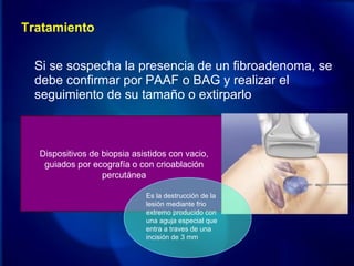 Tratamiento
Si se sospecha la presencia de un fibroadenoma, se
debe confirmar por PAAF o BAG y realizar el
seguimiento de su tamaño o extirparlo
Dispositivos de biopsia asistidos con vacio,
guiados por ecografía o con crioablación
percutánea
Es la destrucción de la
lesión mediante frio
extremo producido con
una aguja especial que
entra a traves de una
incisión de 3 mm
 