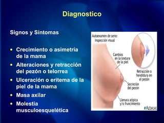 Diagnostico
Signos y Síntomas
• Crecimiento o asimetría
de la mama
• Alteraciones y retracción
del pezón o telorrea
• Ulceración o eritema de la
piel de la mama
• Masa axilar
• Molestia
musculoesquelética
 