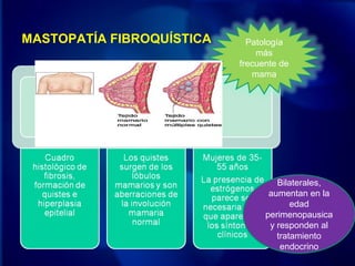 MASTOPATÍA FIBROQUÍSTICA
Bilaterales,
aumentan en la
edad
perimenopausica
y responden al
tratamiento
endocrino
Bilaterales,
aumentan en la
edad
perimenopausica
y responden al
tratamiento
endocrino
Patología
más
frecuente de
mama
 