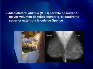 2.-Mediolateral oblicua (MLO) permite observar el
mayor volumen de tejido mamario, el cuadrante
superior externo y la cola de Spence
 