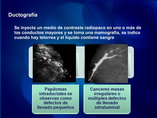 Ductografía
Se inyecta un medio de contraste radiopaco en uno o más de
los conductos mayores y se toma una mamografía, se indica
cuando hay telorrea y el líquido contiene sangre
 